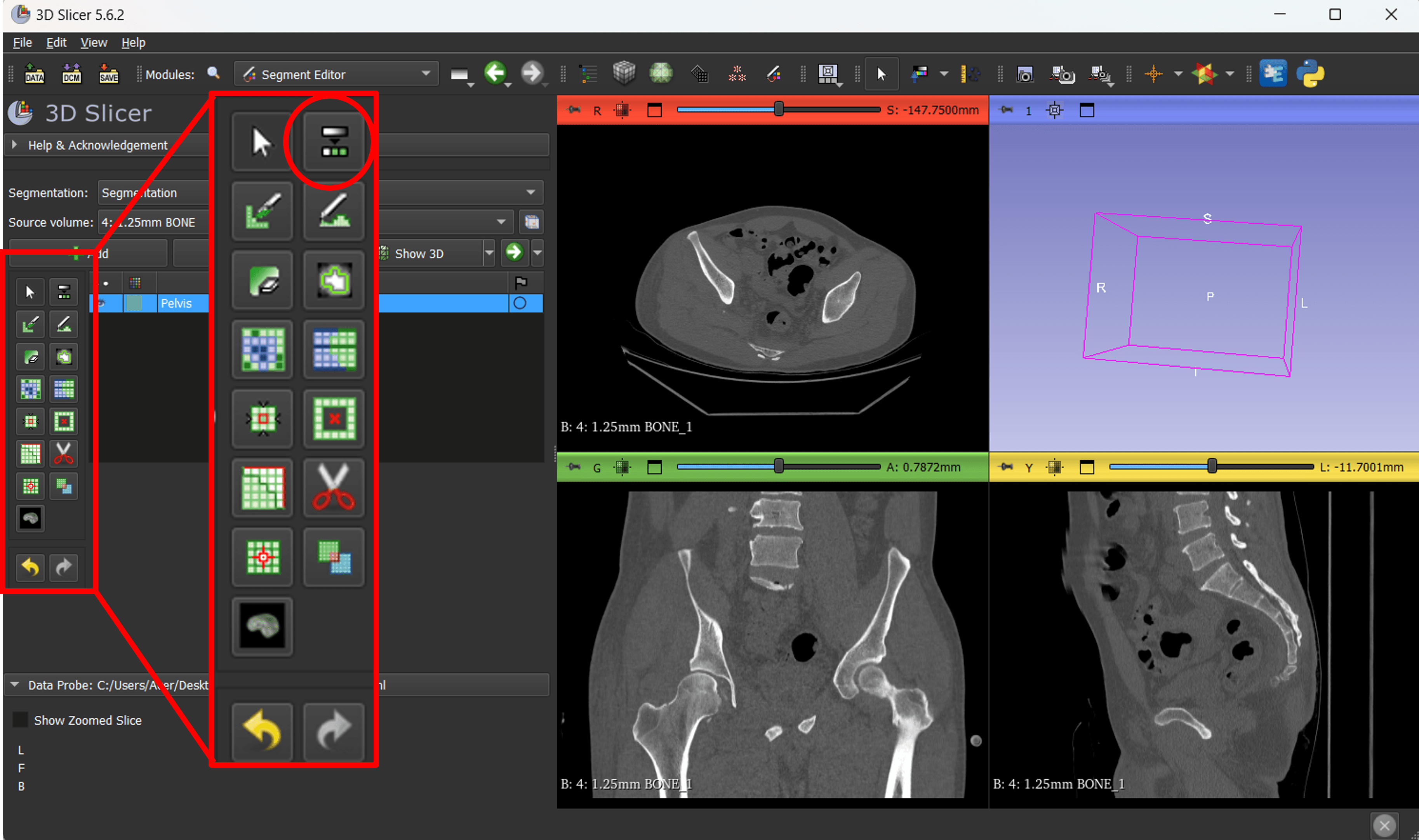 Virtual Surgical Planning for Pelvis Reconstruction course