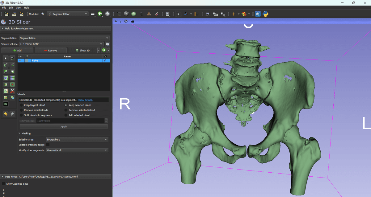Virtual Surgical Planning for Pelvis Reconstruction course