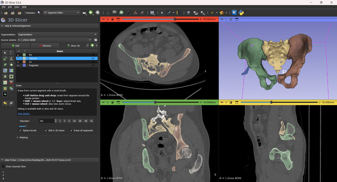 Virtual Surgical Planning for Pelvis Reconstruction course