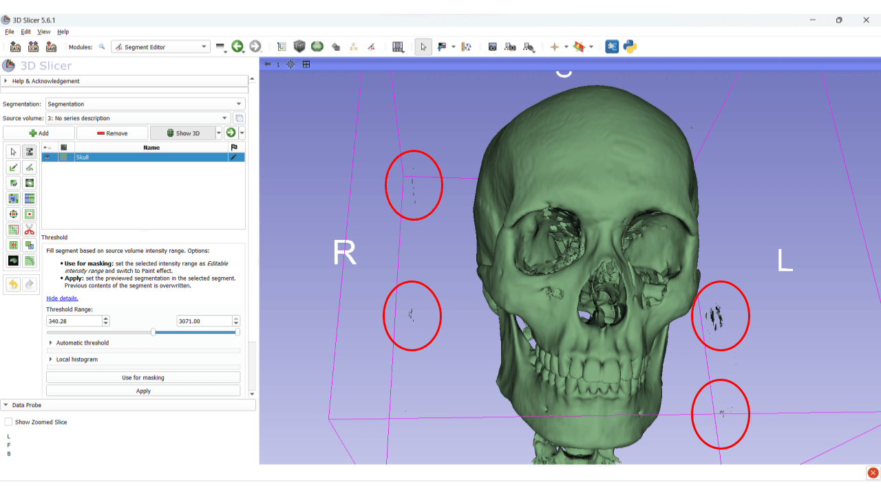 Virtual Surgical Planning for Mandibular Reconstruction course