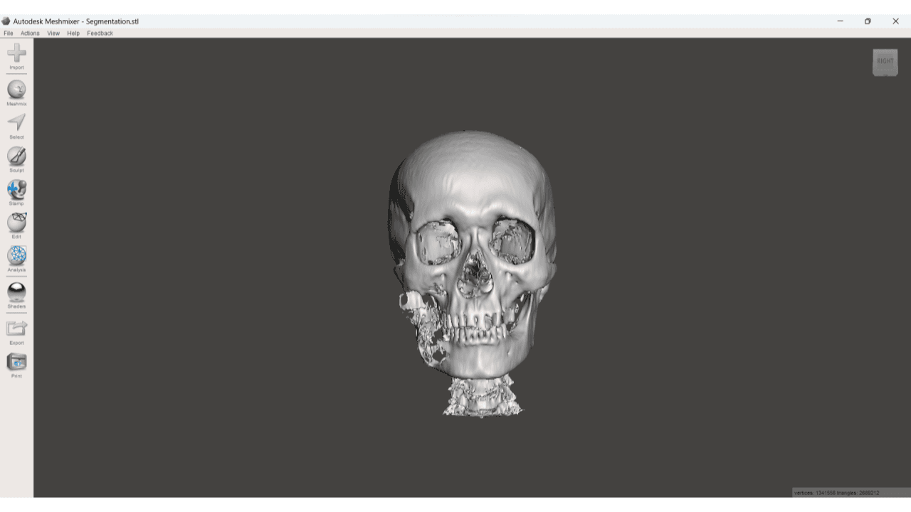 Virtual Surgical Planning for Mandibular Reconstruction course