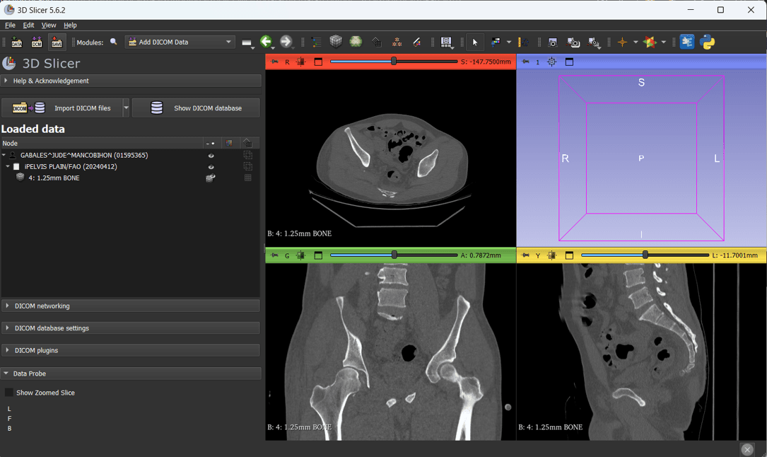 Virtual Surgical Planning for Pelvis Reconstruction course