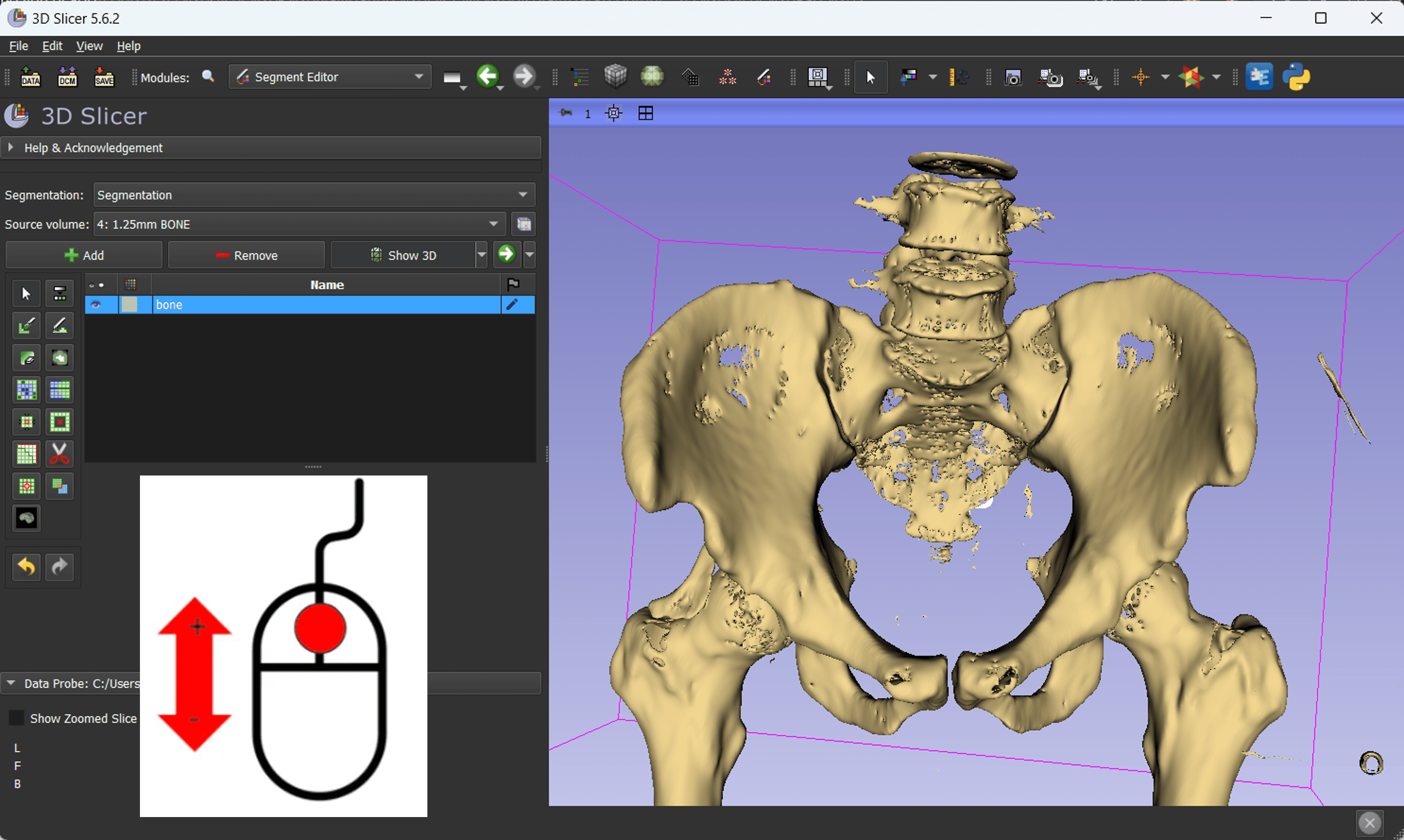 Pelvis Reconstruction