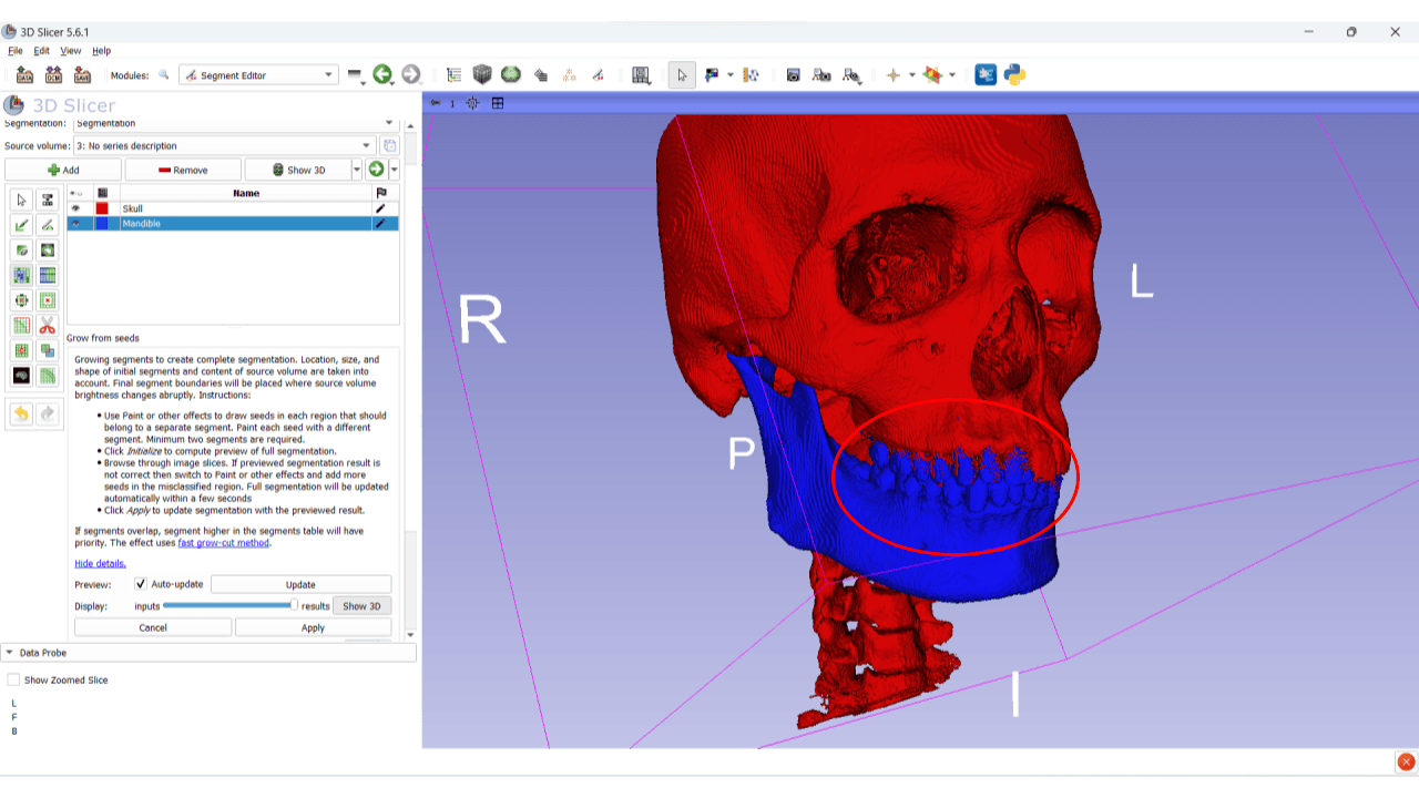 Mandibular Reconstruction